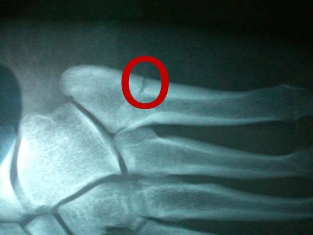 X-Ray of my broken foot.